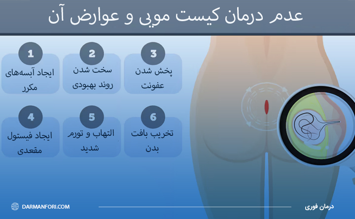 عوارض درمان نکردن کیست مویی