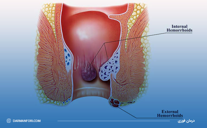 آشنایی با تفاوت بواسیر داخلی و خارجی