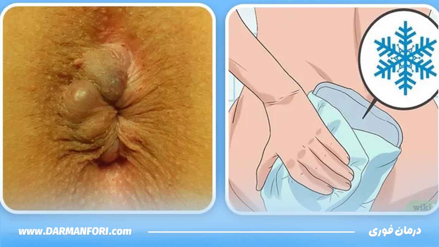 تسکین فوری درد بواسیر با کمپرس یخ