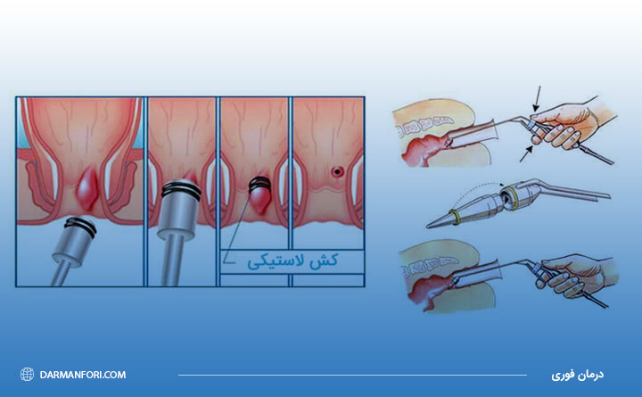 استفاده از رابربند برای درمان هموروئید درجه یک