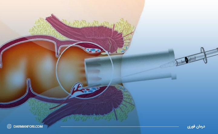 نحوه انجام اسکلروتراپی هموروئید
