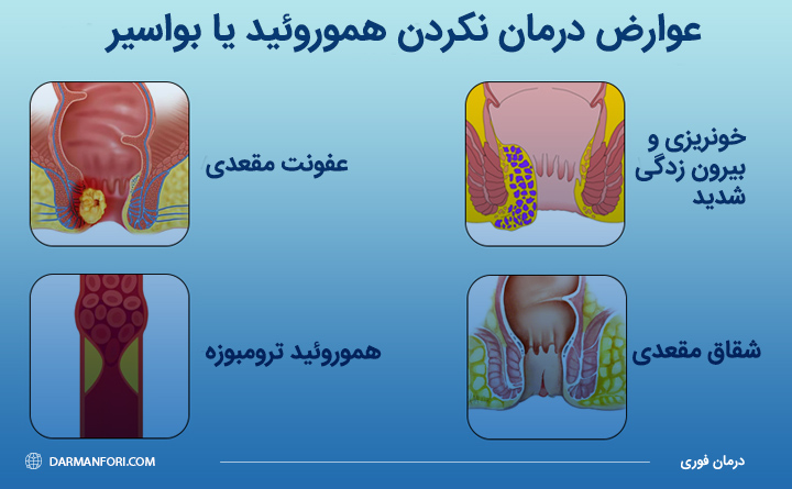 درمان نکردن بواسیر چه عوارضی دارد؟