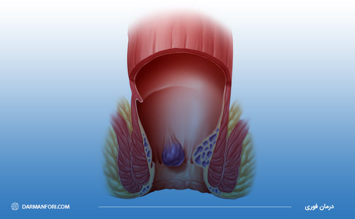 آشنایی با بواسیر یا هموروئید داخلی