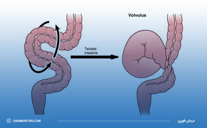 آشنایی با پیچ خوردگی روده یا ولولوس