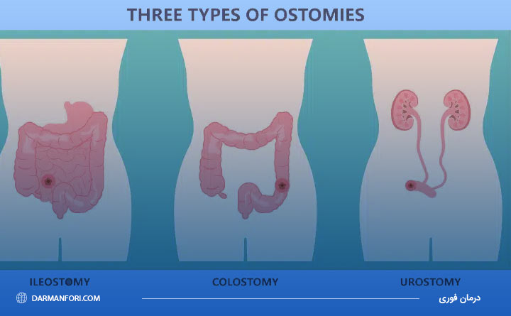 انواع استومی