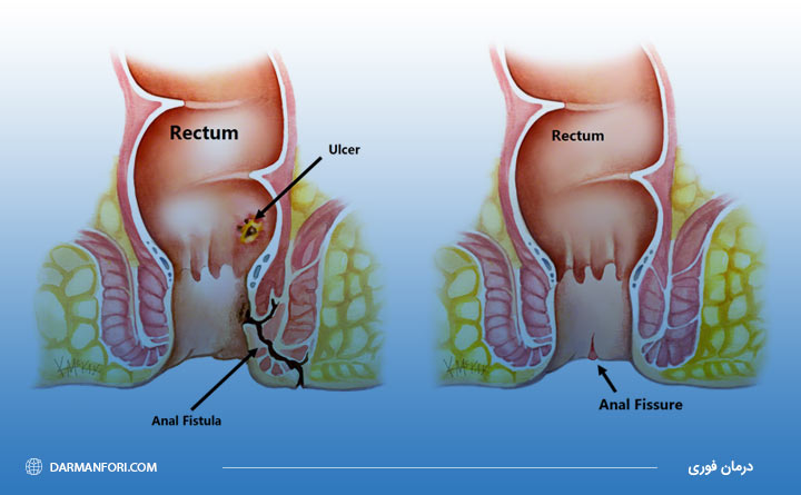 آشنایی با تفاوت شقاق و فیستول