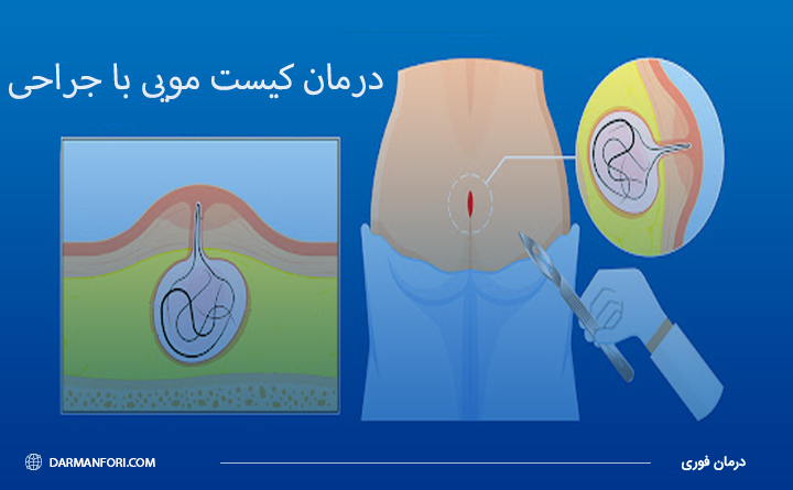 جراحی کیست مویی