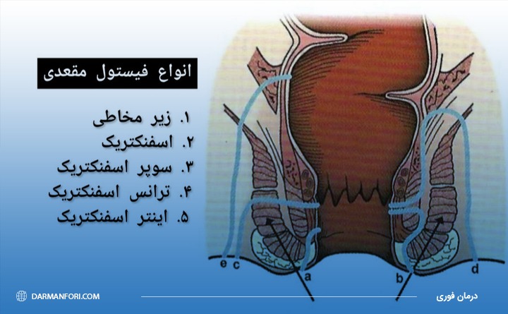 انواع فیستول مقعدی 