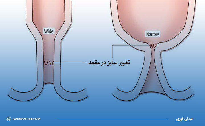 تعریف گشادی مقعد