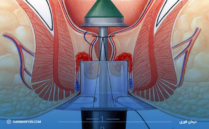 عمل جراحی بواسیر با استاپلر