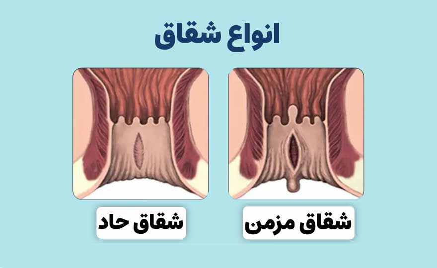 تصویر مقایسه‌ای انواع شقاق مقعدی شامل شقاق حاد و شقاق مزمن، همراه با تفاوت‌های ظاهری زخم و علائم شقاق
