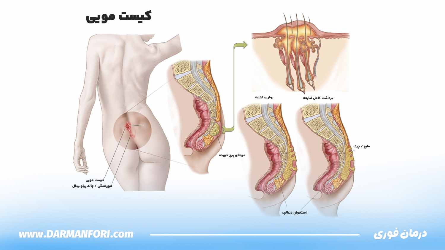 محل کیست مویی دنبالچه ایلوستریشن