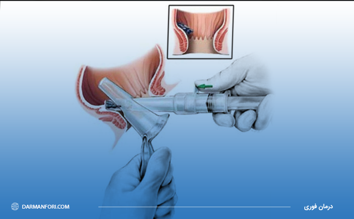 روش درمان بواسیر با رابربند