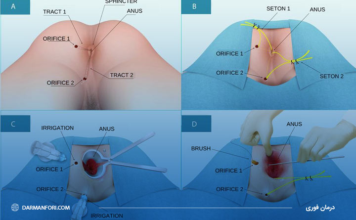  پس از جراحی فیستول