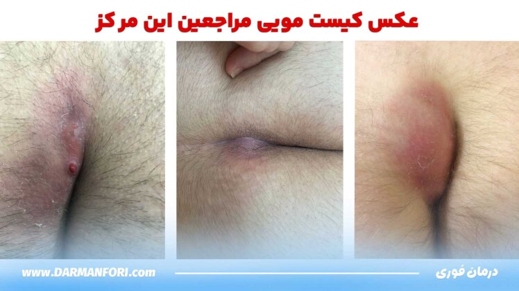 علائم اولیه کیست مویی + عکس