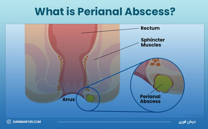 درمان آبسه مقعدی 