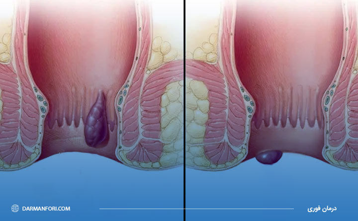 تفاوت هموروئید خارجی و داخلی