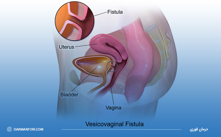 فیستول واژینال چیست 