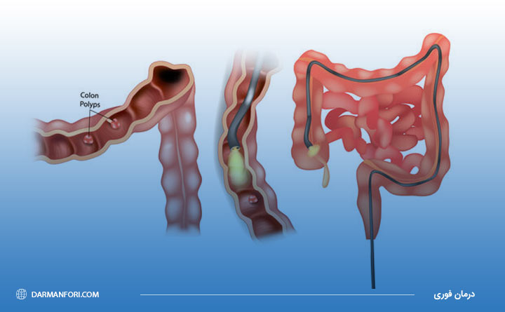 سیگموئیدوسکوپی (Sigmoidoscopy