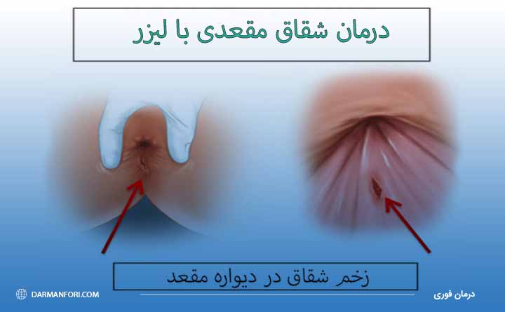 لیزر شقاق مقعدی