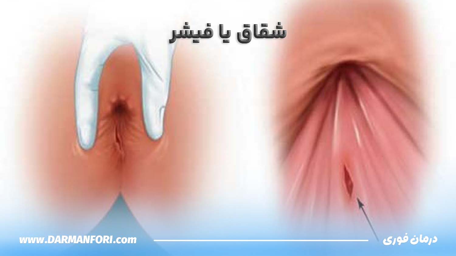 شقاق یکی از شایع‌ترین عوارض ناشی از سکس مقعدی