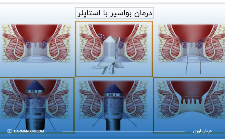 درمان بواسیر با استاپلر