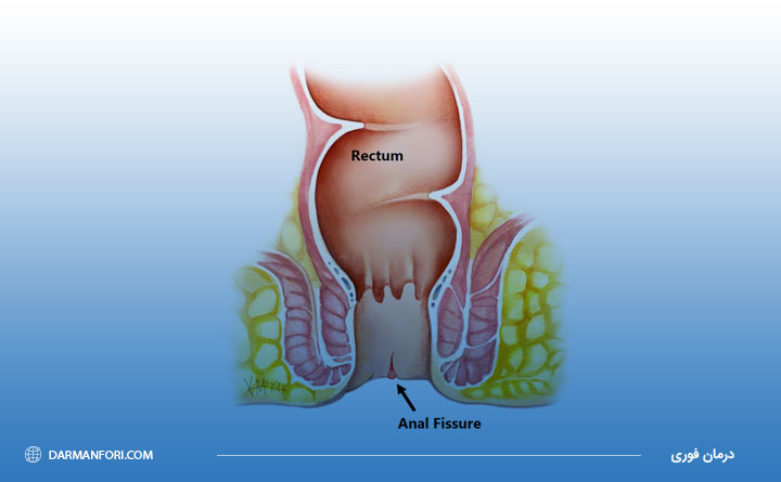 بیماری شقاق از دلایل گشادی مقعد