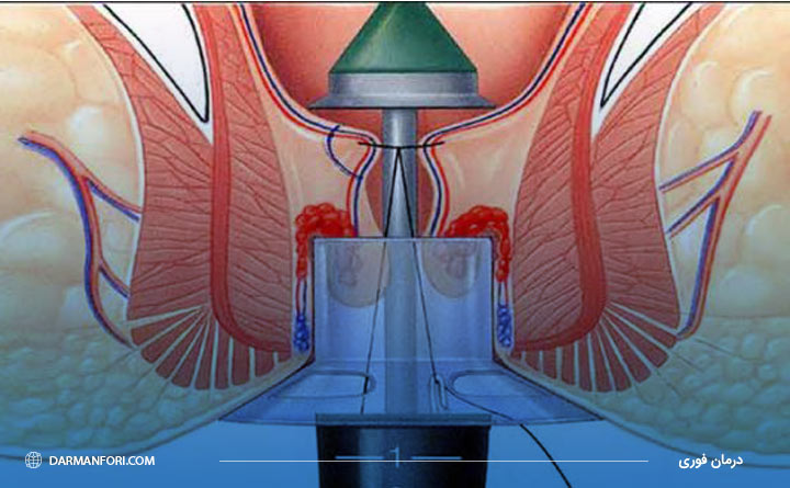 استفاده از استاپلر برای درمان بواسیر 