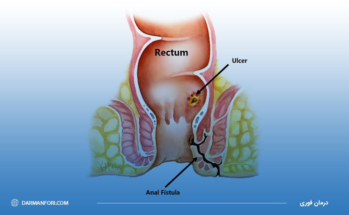 آشنایی با فیستول مقعدی