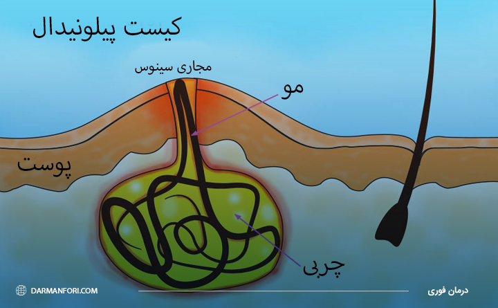 کیست پیلونیدال چیست؟