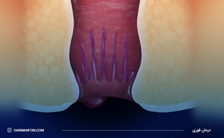 آیا هموروئید باعث سرطان می شود؟