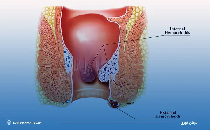 بواسیر یا هموروئید علت زخم مقعد
