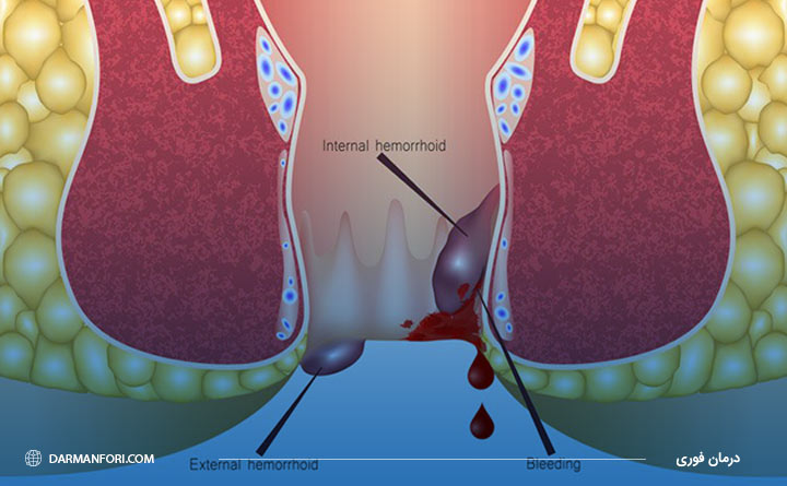 تاثیر بیماری‌های هموروئید و شقاق در بدن
