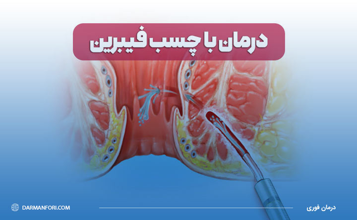 استفاده از چسب فیبرین برای جراحی فیستول مقعدی