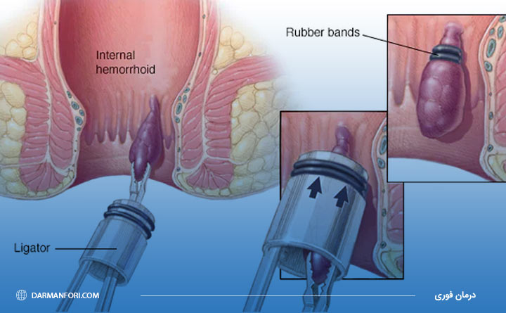  درمان هموروئید خونی با رابربند
