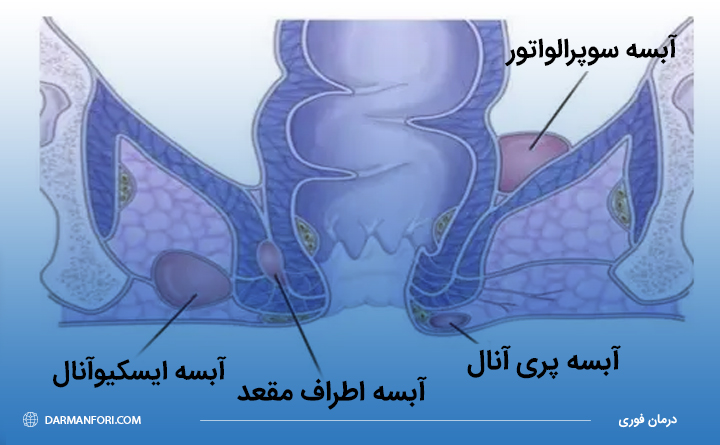 آبسه مقعدی چیست؟