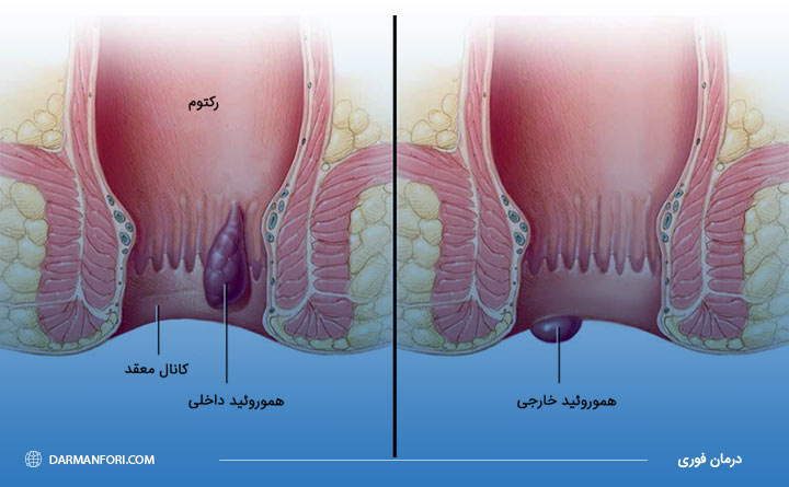 تفاوت بواسیر داخلی و خارجی 