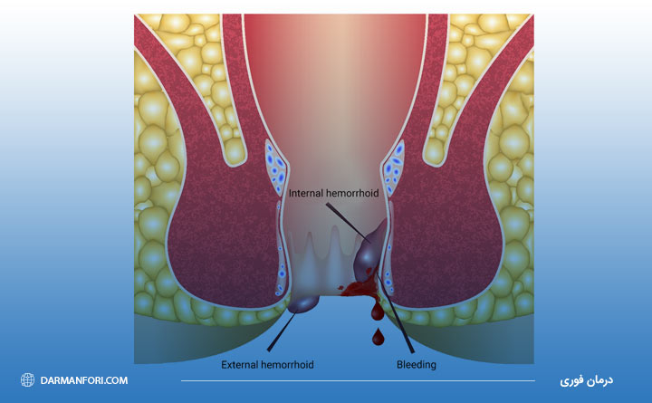 بواسیر خونی (هموروئید) داخلی