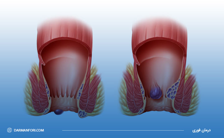 درمان هموروئید داخلی و خارجی با هموروئیدکتومی