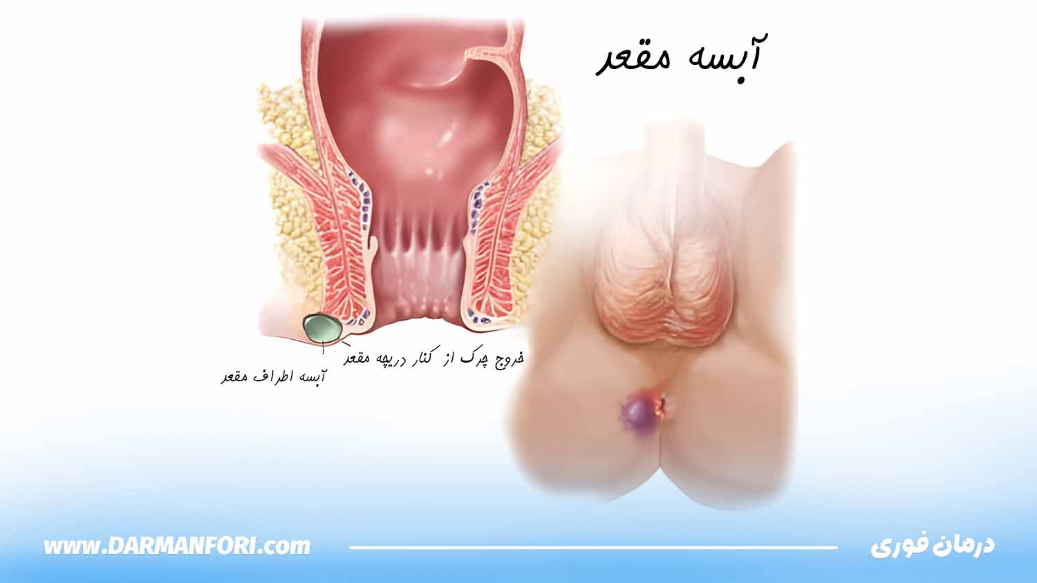 آبسه مقعدی به عنوان یکی از علتهای سوزش و درد شدید بعد از اجابت مزاج