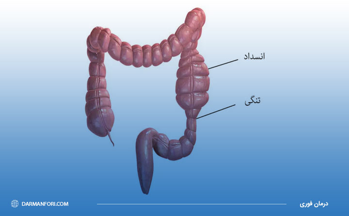 انسداد روده از علائم پولیپ رکتوم