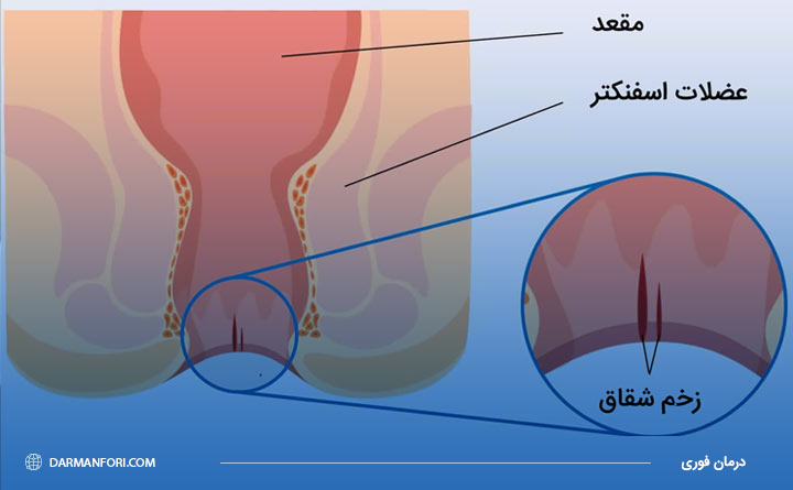 درمان زخم شقاق